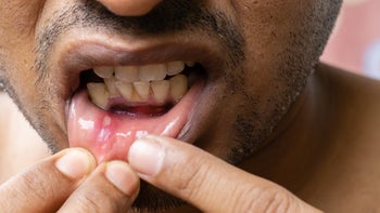Canker sore: man closeup canker sore 1403497875