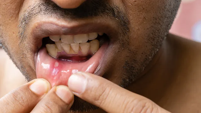 Canker sore: man closeup canker sore 1403497875