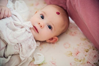 children's health: hemangioma: baby: babies: GettyImages-947065776