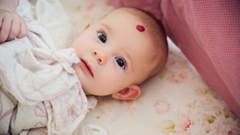 children's health: hemangioma: baby: babies: GettyImages 947065776