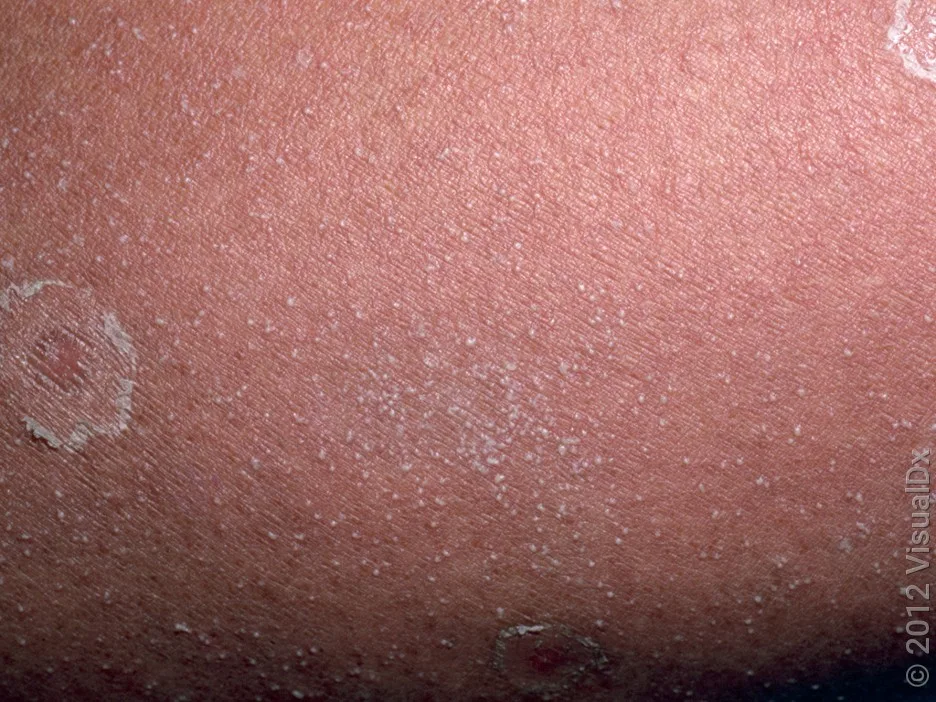 Close-up of skin with many tiny, white pus bumps and round scaly patches.