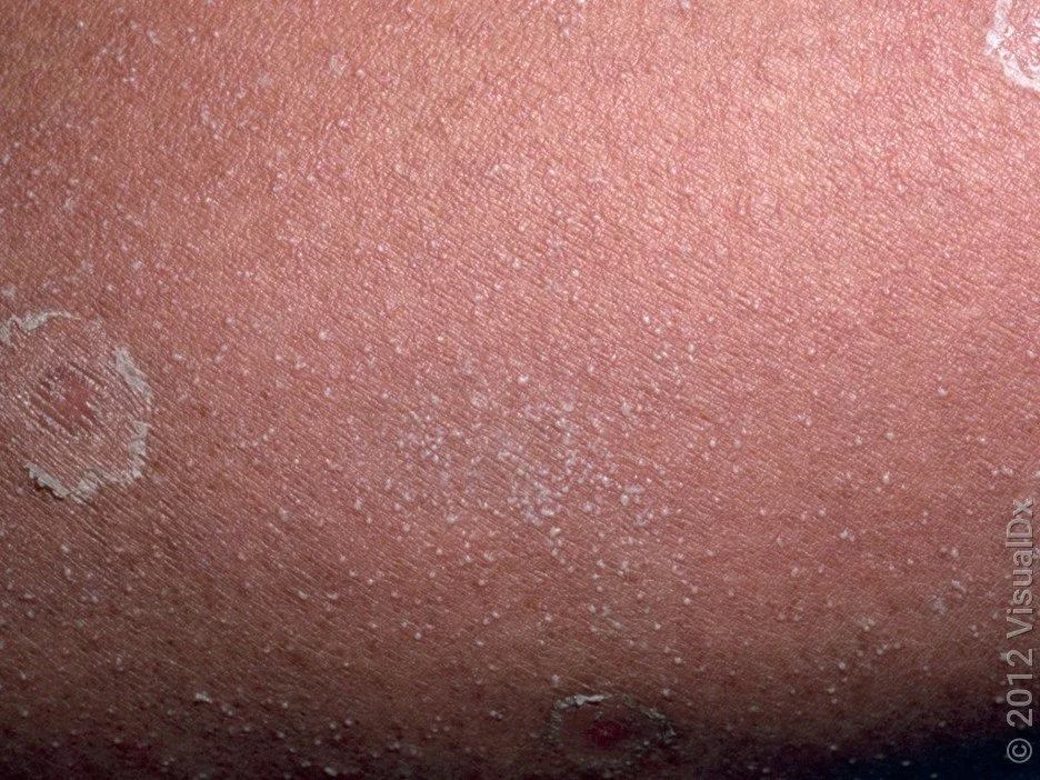 Close-up of skin with many tiny, white pus bumps and round scaly patches. 