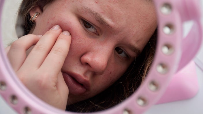 A person examining their acne in a mirror.