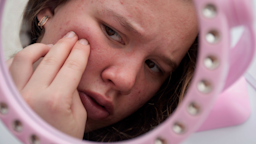 The cost of laser acne scar removal can range from $200 to $3,000. Learn what affects prices and how many sessions are needed so you can decide if it’s worth it.