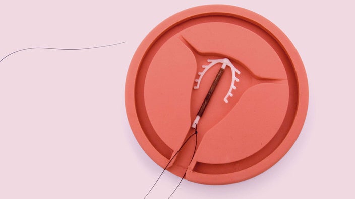 What it's like to get an IUD coil fitted and how does it work?