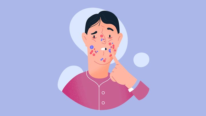 the best antibiotic for acne