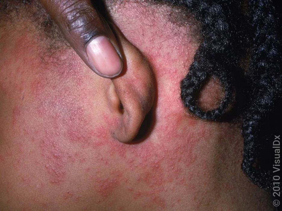 The measles rash starts at the hairline and spreads down to the rest of the body.