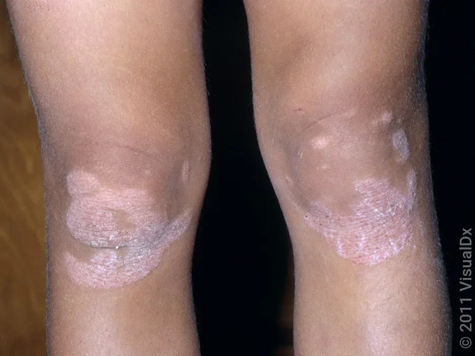 Psoriasis on the knees.