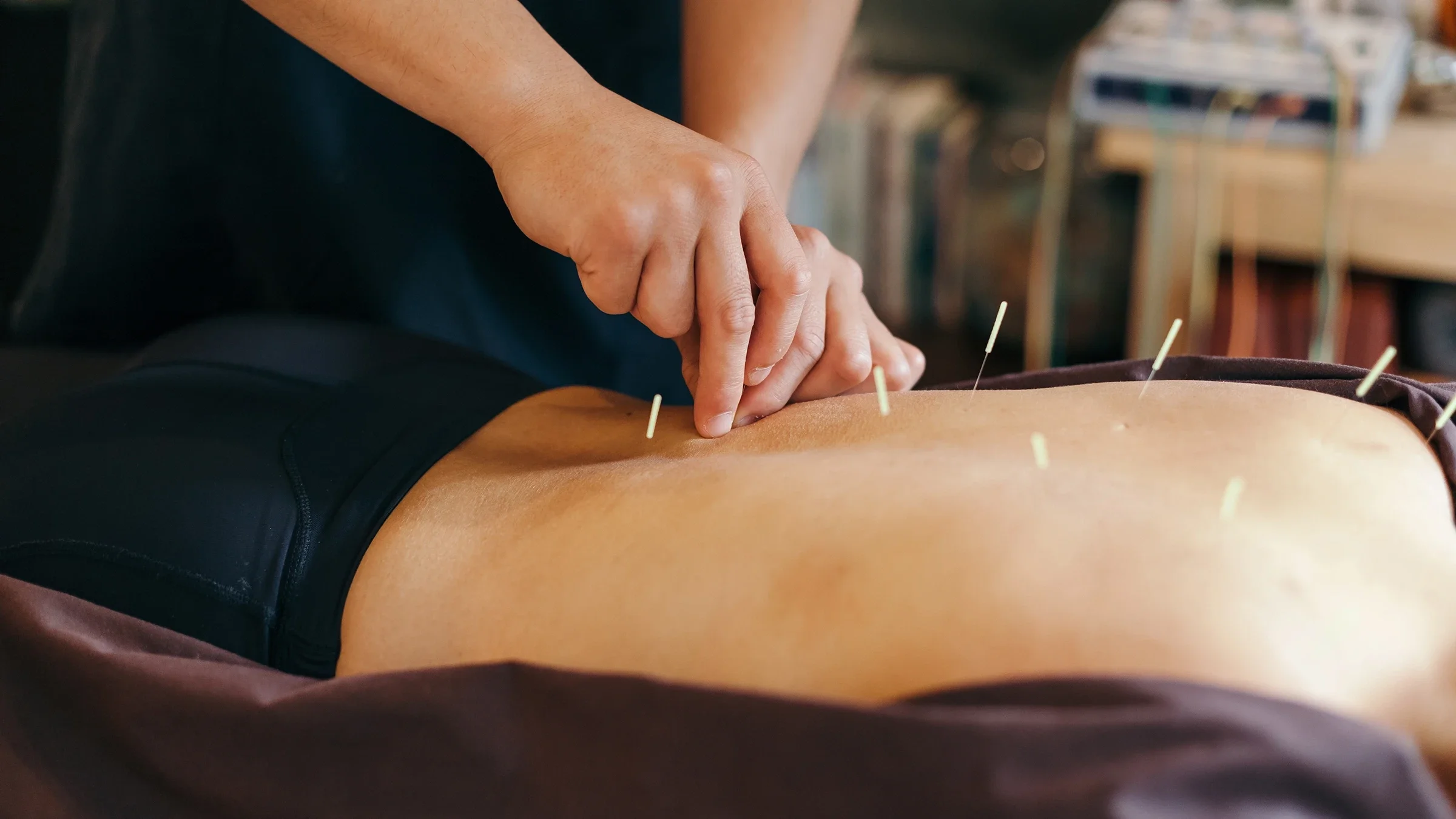 Close-up of an acupuncture session.
