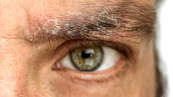 Lydighed landmænd spade Why Do I Have Eyebrow Dandruff? Seborrheic Dermatitis Explained - GoodRx