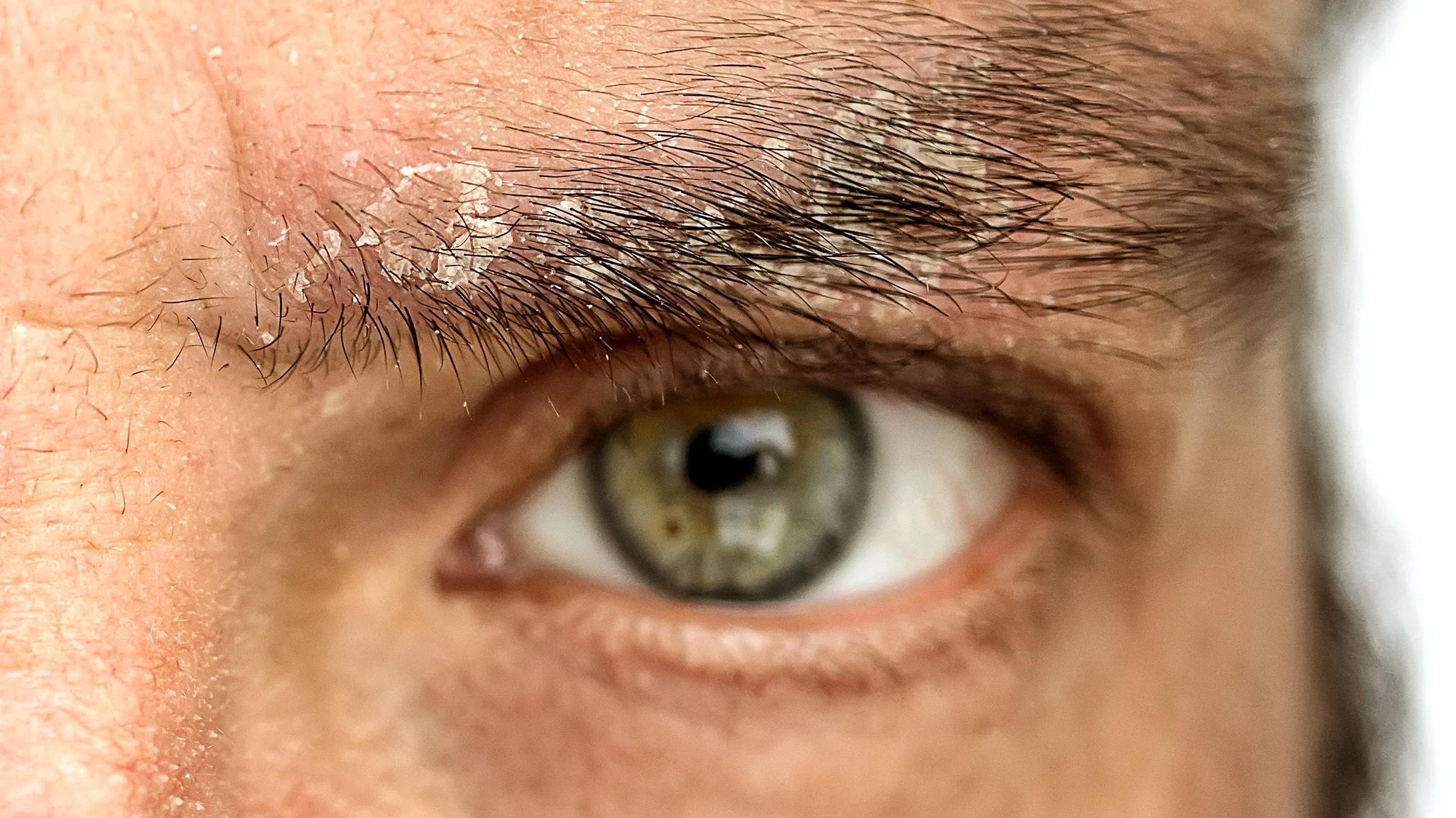 Extreme close-up on a man’s eyebrow showing flaky skin.
Sergey Dogadin/iStock via Getty Images