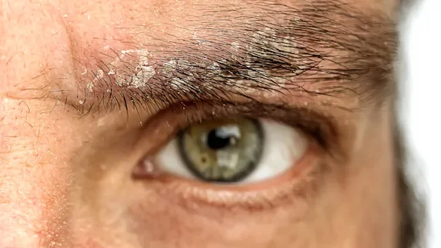 Why Do I Have Eyebrow Dandruff? Seborrheic Dermatitis Explained