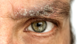 Eyebrow dandruff (seborrheic dermatitis) can be itchy and irritating, but fortunately you can treat it with OTC remedies. Here’s how to get rid of dry, flaky eyebrows.
