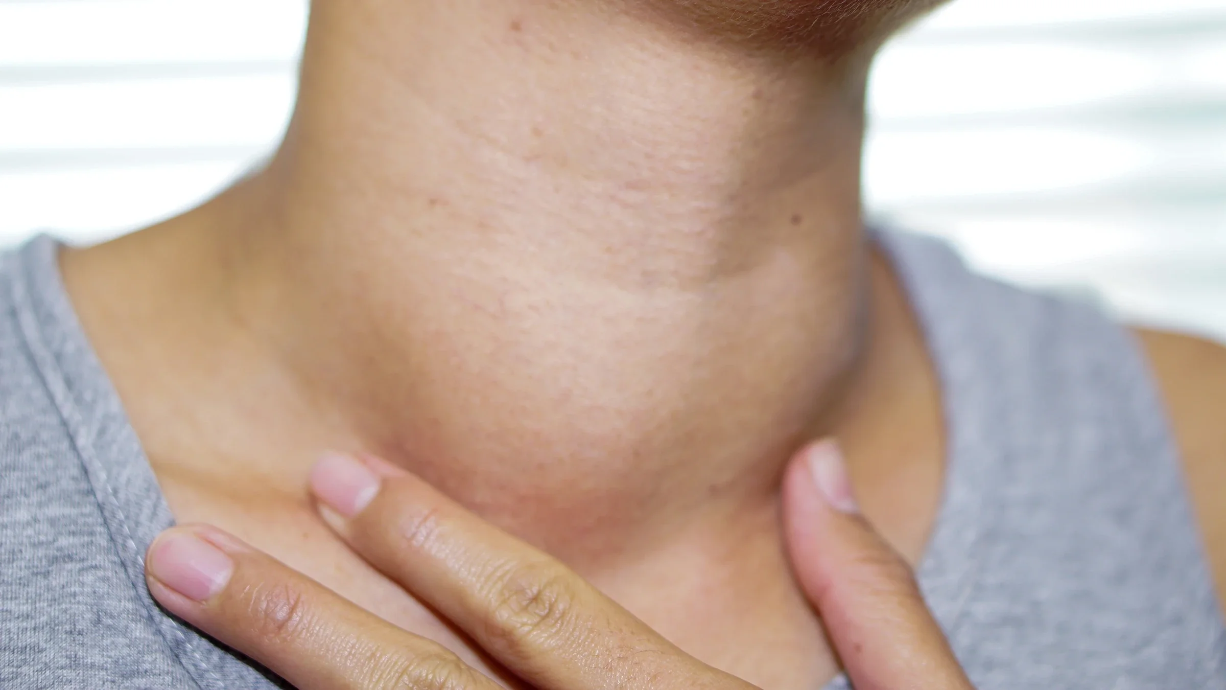Cropped close-up shot of a woman's enlarged thyroid.