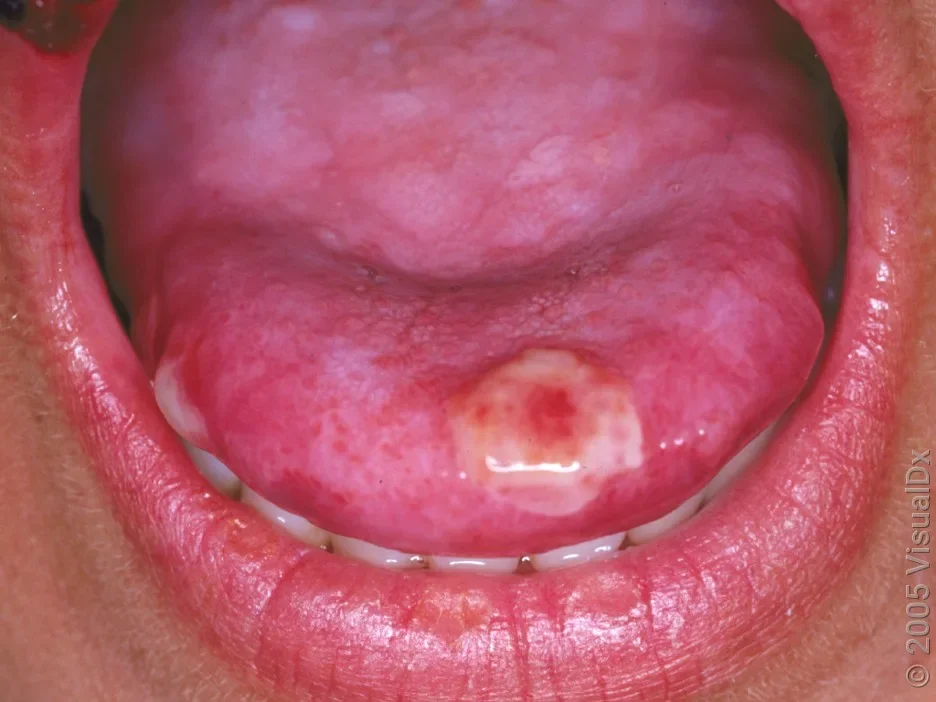 Close-up of a cold sore on the tongue.