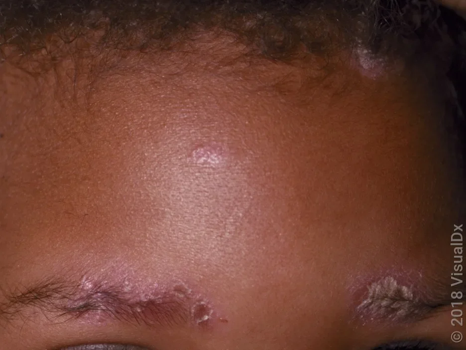 Close-up of a forehead with light pink scaly patches caused by psoriasis.
