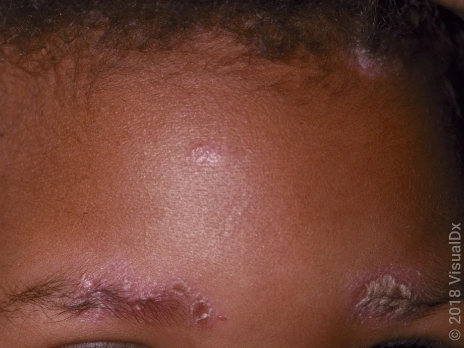 Close-up of a forehead with light pink scaly patches caused by psoriasis.