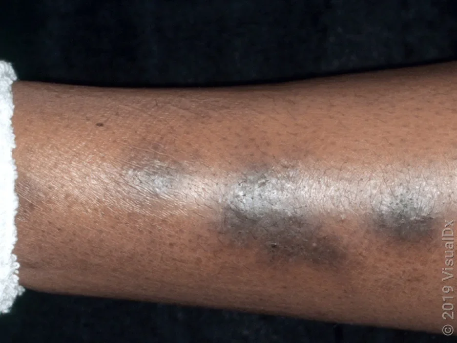 Dark patches caused by hyperpigmentation on Black skin.