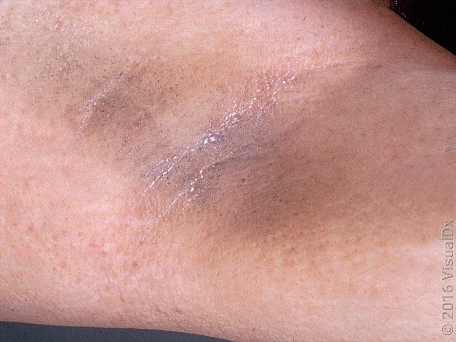 A close-up look at acanthosis nigricans in the armpit. 