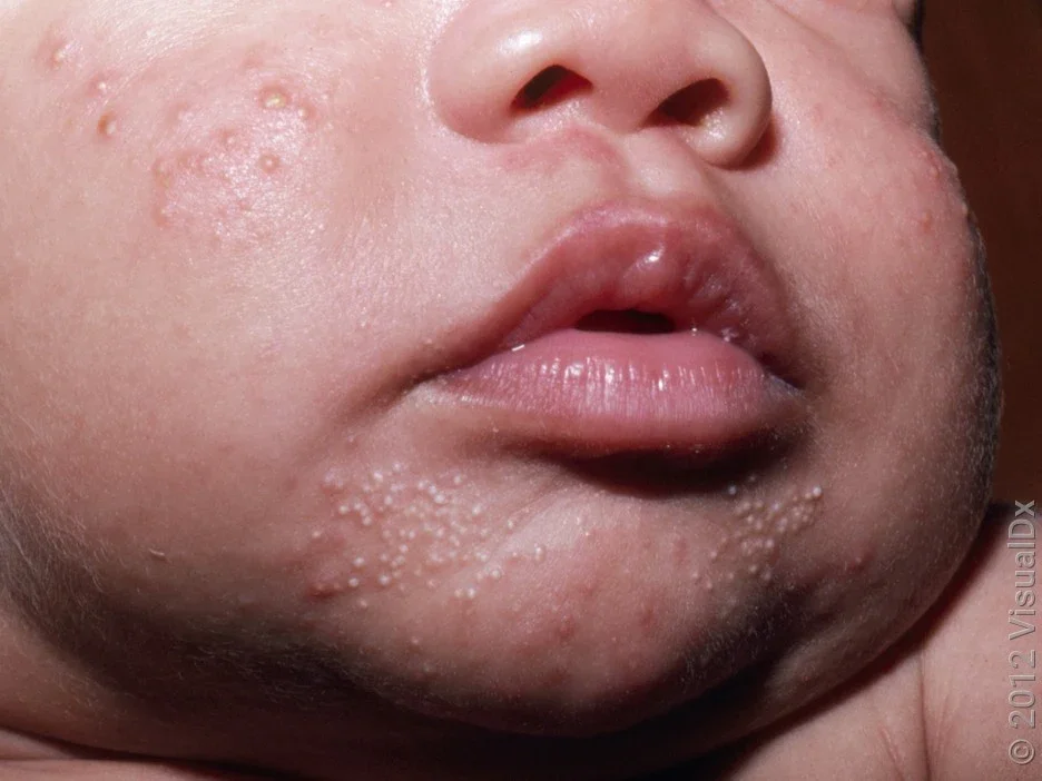 Close-up of milia on the face.