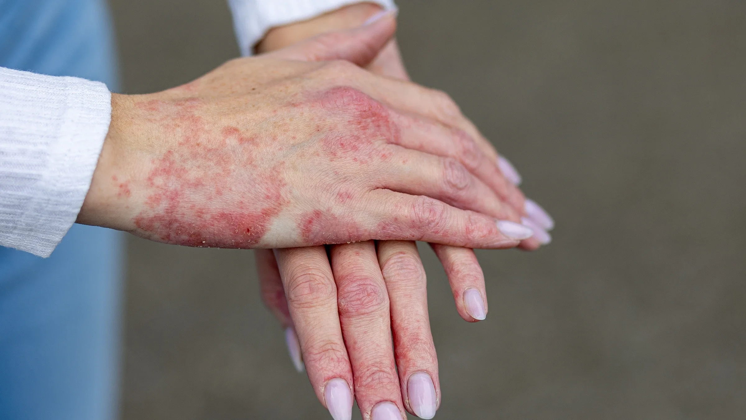 The image shows a person’s hands during a psoriasis flare.