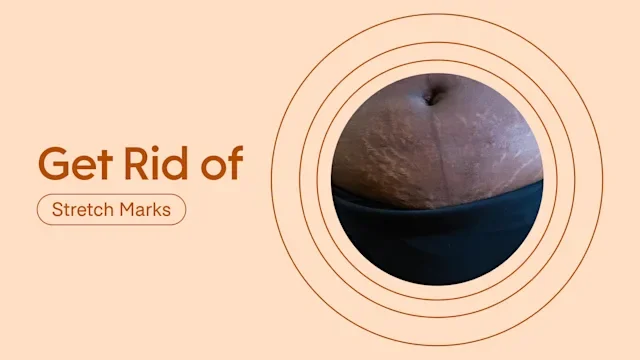 PEx: Stretch marks: rid featured image