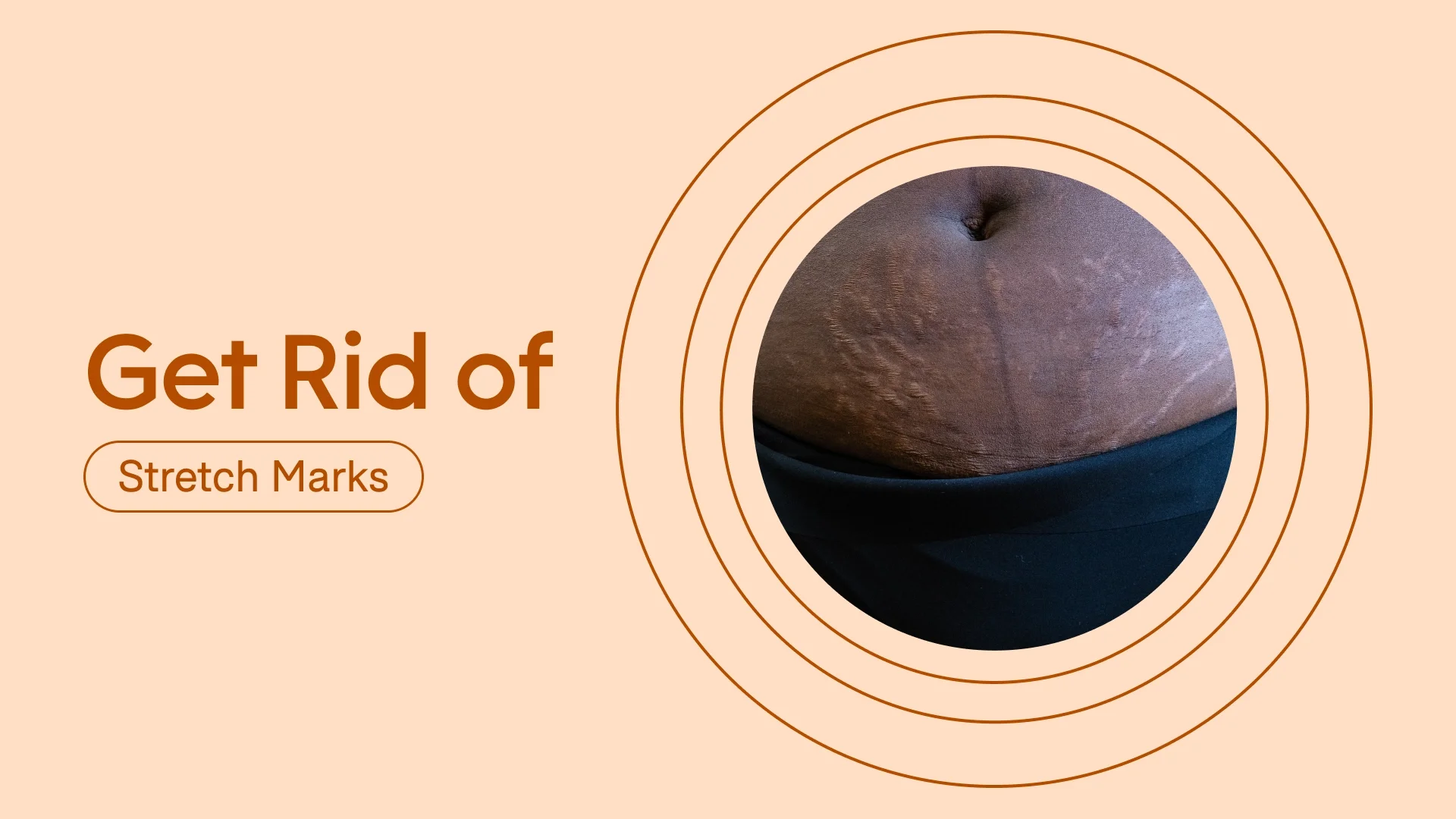 Light red background with dark red text reading: “Get Rid of Stretch Marks” on the left side. On the right, is a circular cropped image of stretch marks up-close with red circular lines radiating out from the photo.