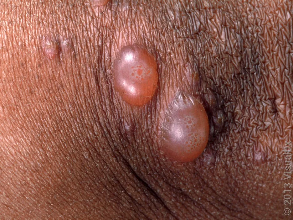 Two fluid-filled blisters in the armpit.