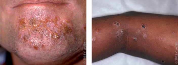 Left: Patches of oozing and yellow crusting on the chin. Right: Several brown and pinky round crusty patches on the back of the leg.