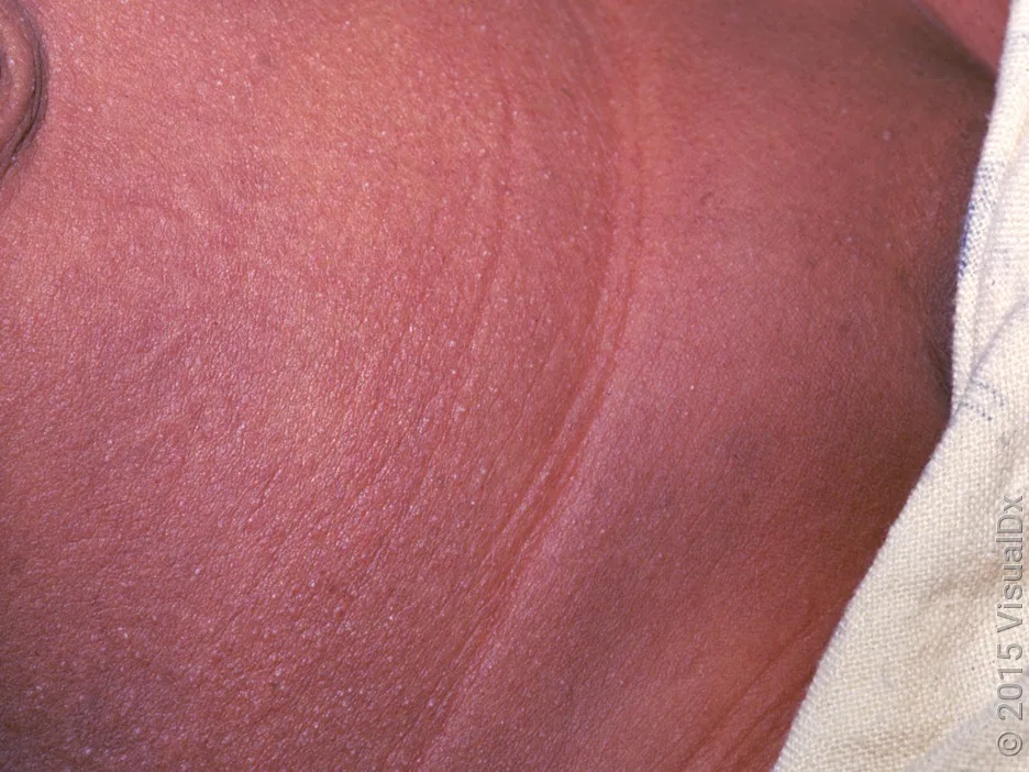 Close-up of scarlet fever rash with widespread violet bumps.