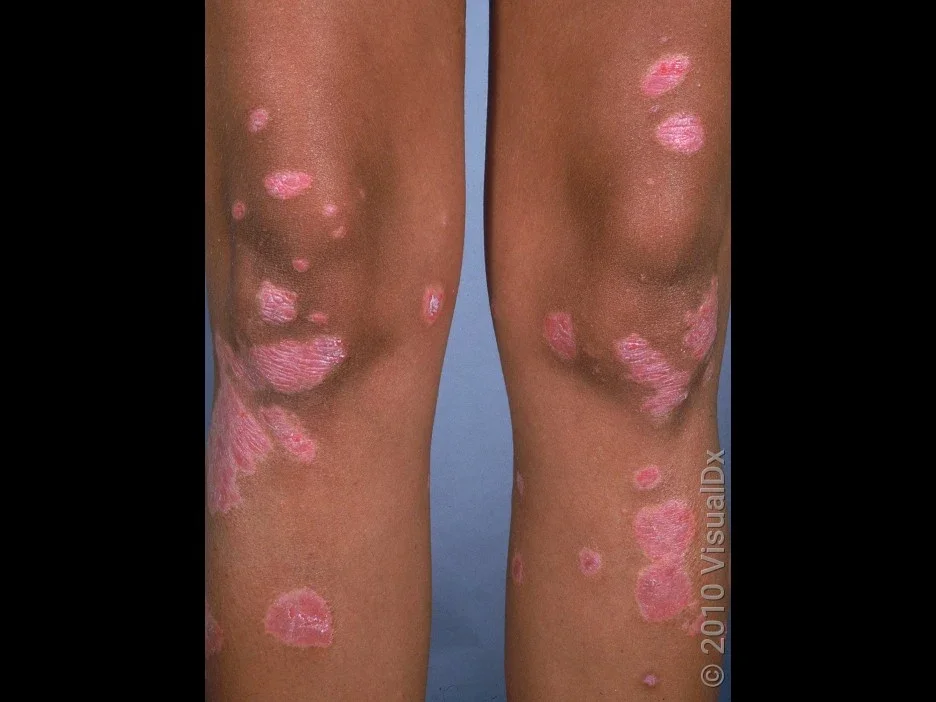 Plaque psoriasis on the legs in darker skin. 