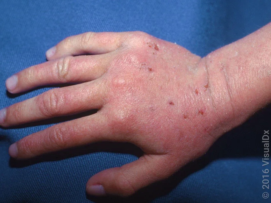 An eczema rash on the back of the hand.