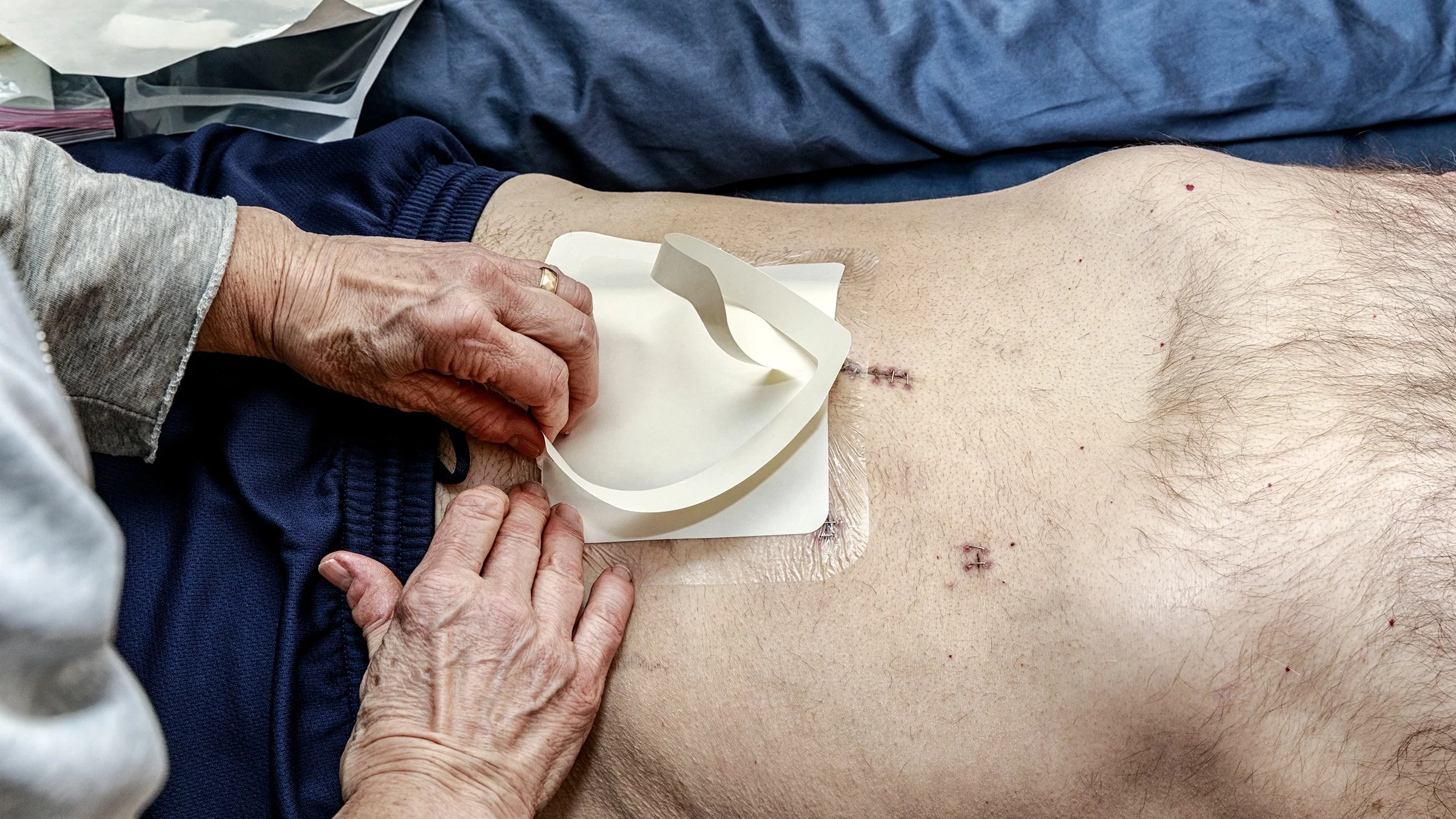 Close-up of a caregiver switching out the bandages on a colon cancer patient's abdomen.