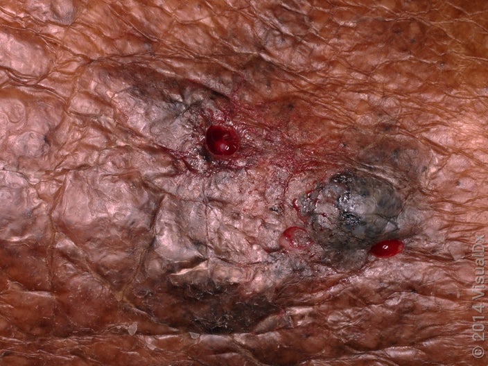 Close-up of a pigmented basal cell carcinoma on darker skin. 