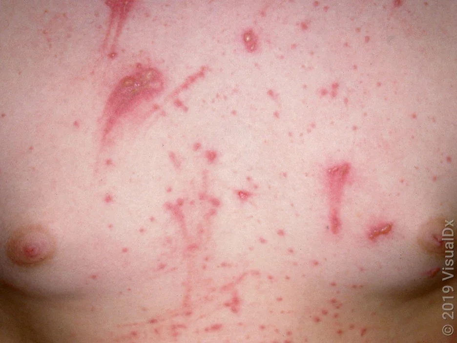 Close-up of full-blown poison ivy bumps on the chest.