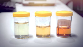 Health: Urology: urine samples in lab-698654448