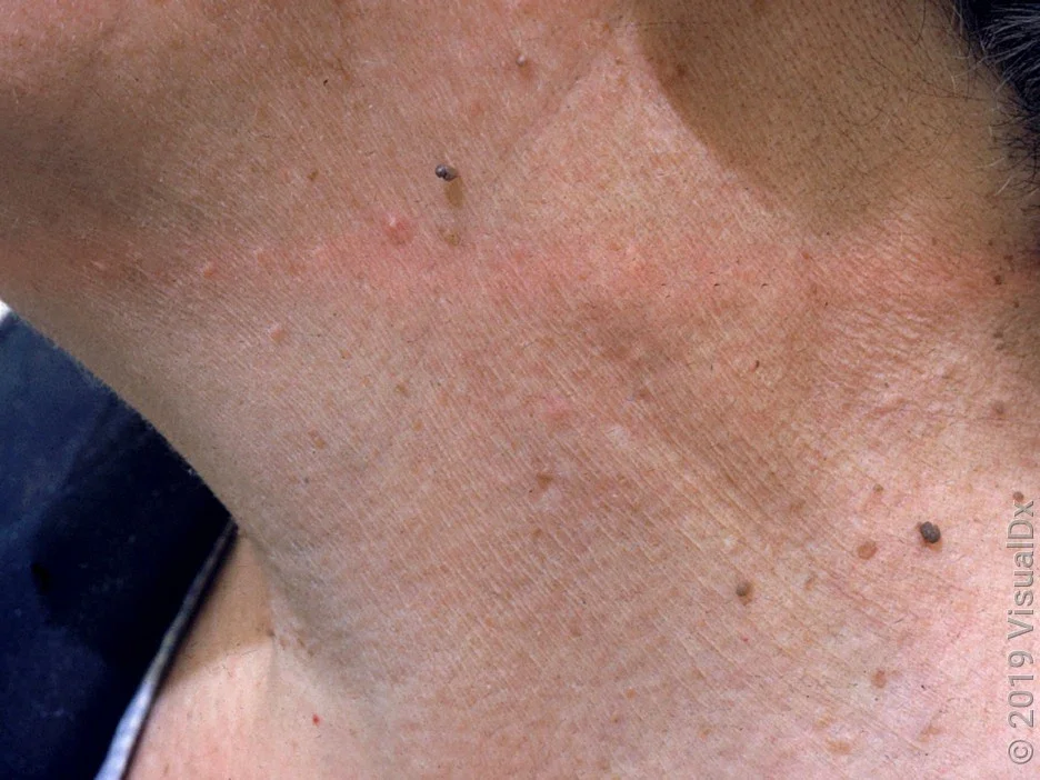 Close-up of multiple skin tags on the neck. 