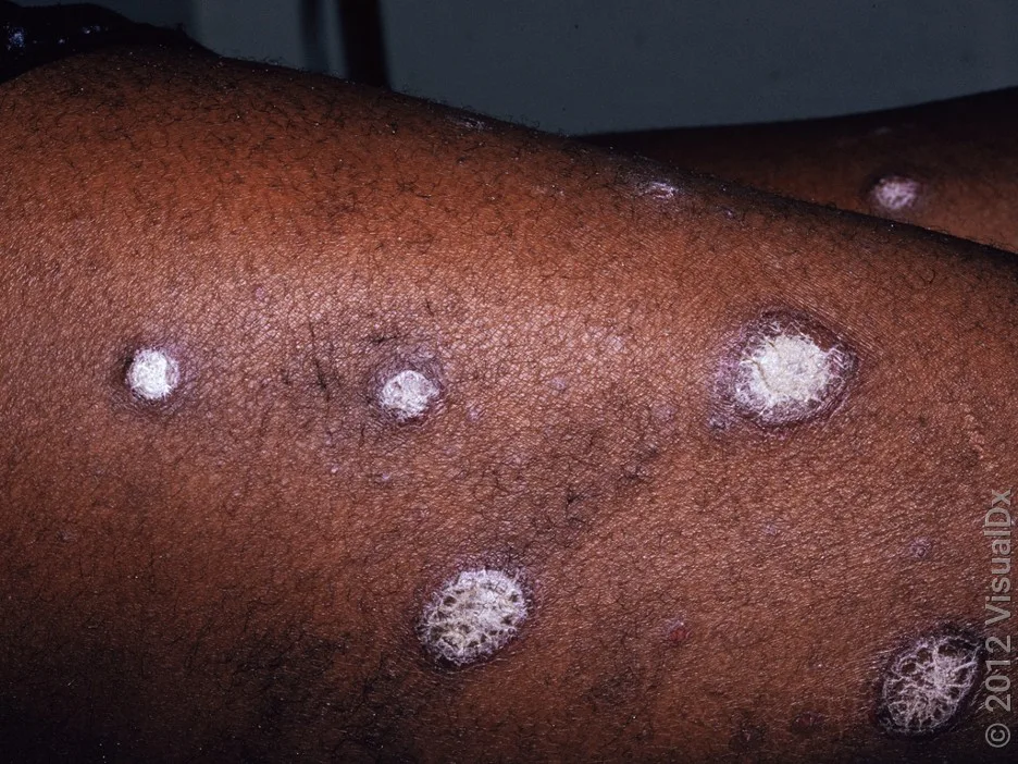 Close-up of skin with small, thick, brown patches covered in white scale caused by psoriasis.