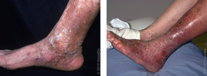 Venous stasis dermatitis deals