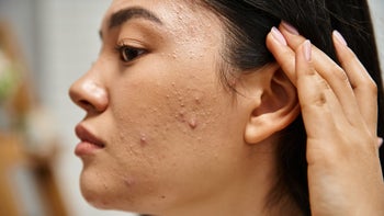 cabtreo: closeup face with acne 2178839435