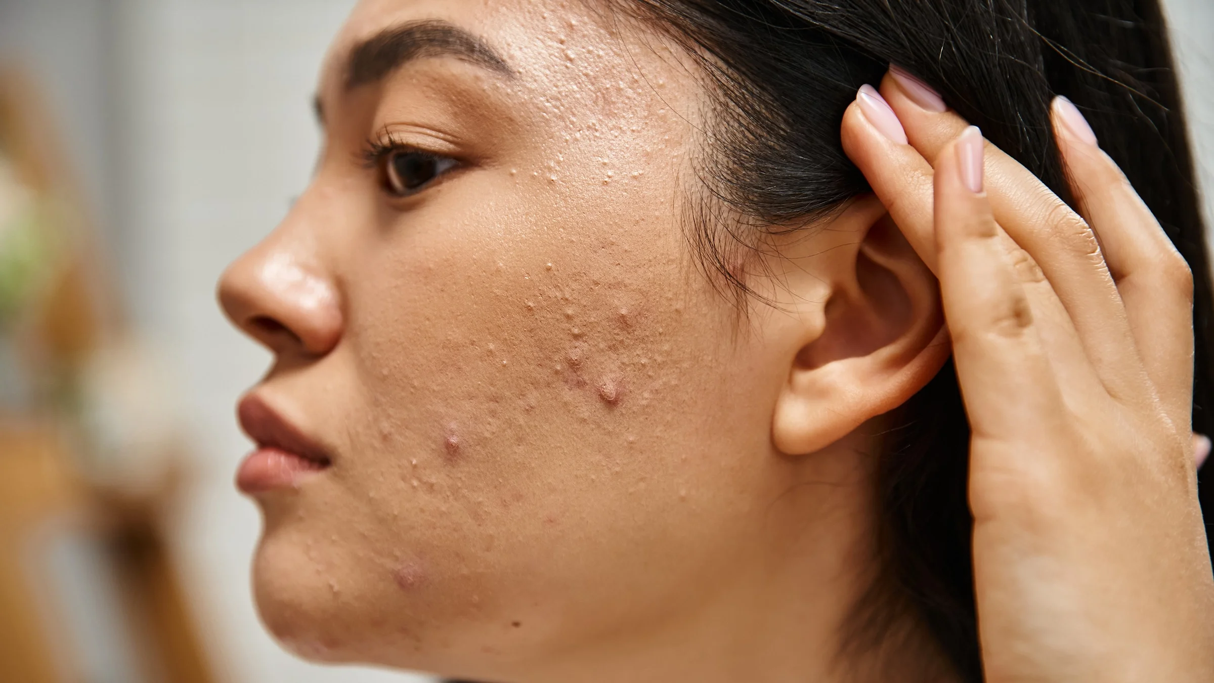 A woman examines the acne on her cheek. 