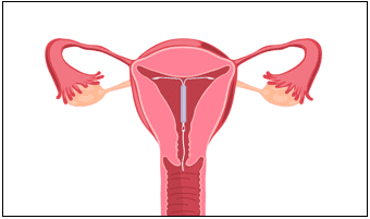 IUD placement illustration