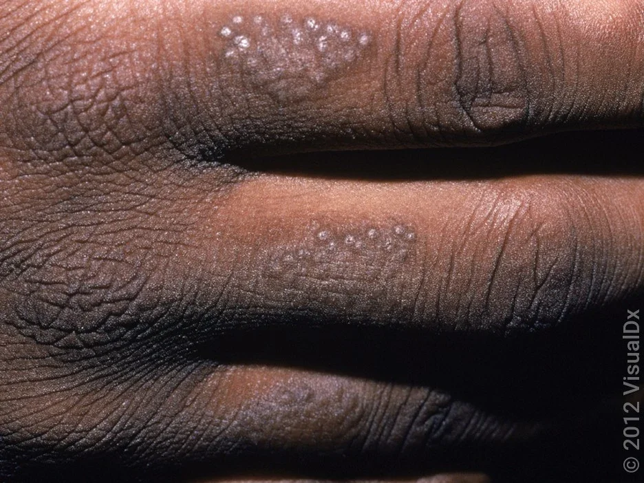 Scaly patches caused by eczema on the finger.