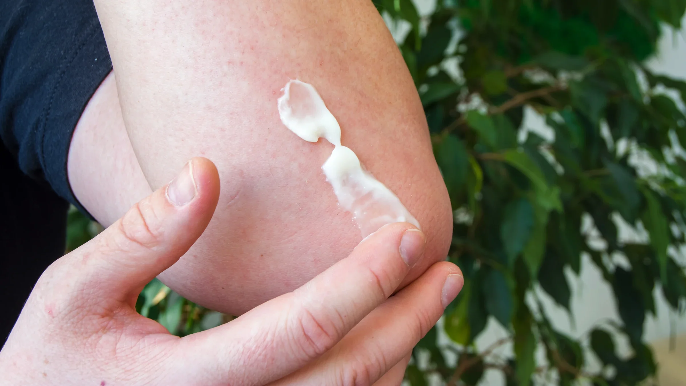 Close-up applying ointment on arm
Shidlovski/iStock via Getty Images Plus     

