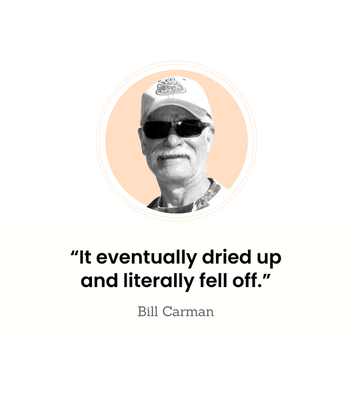 Bill Carman is pictured in a snapshot, with the quote “It eventually dried up and literally fell off.”