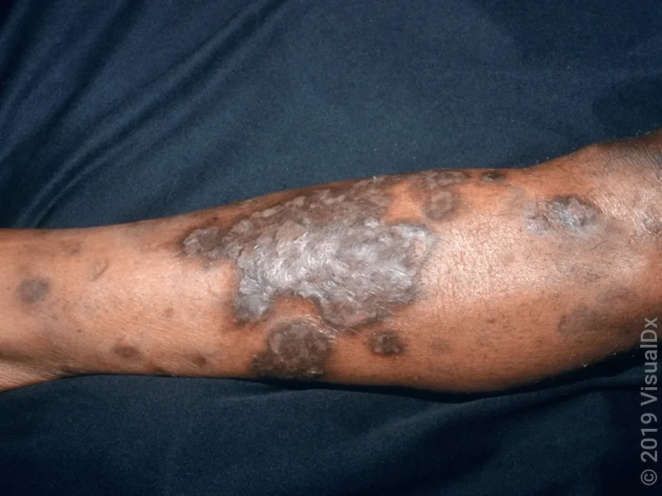 Dark patches on the leg from diabetic dermopathy.