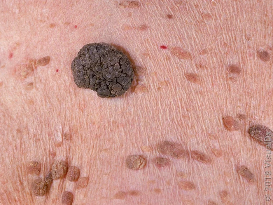 Close-up of several seborrheic keratoses.