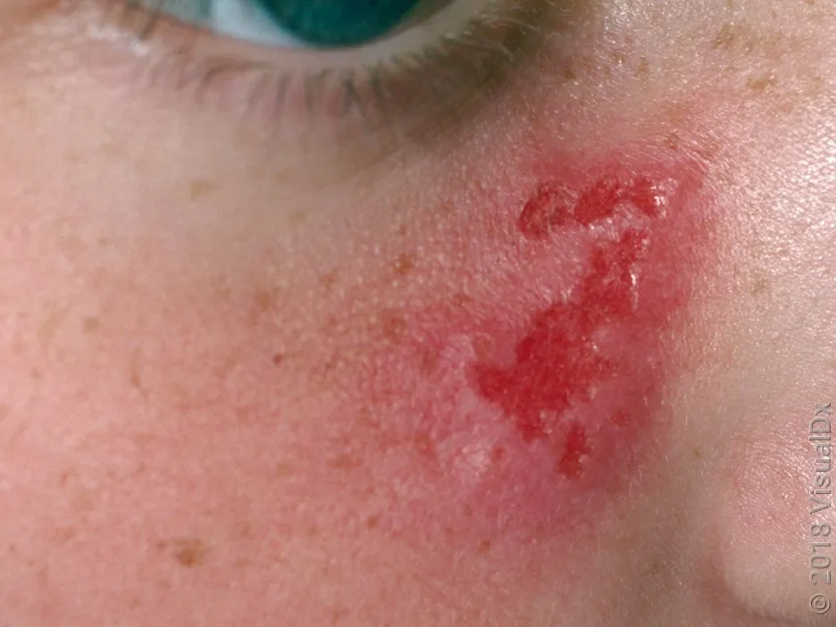 Close-up of open sores from herpes on the cheek.