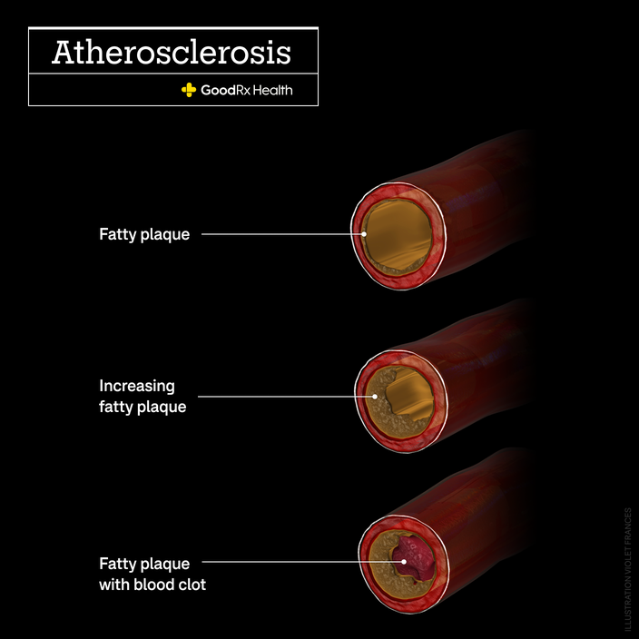A 3D illustration of atherosclerosis, two arteries with fatty plaque, and an artery with fatty plaque and a blood clot.