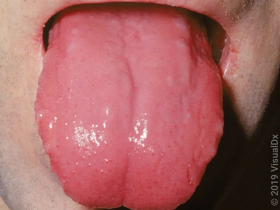 Close-up of a red tongue (strawberry tongue) in scarlet fever.